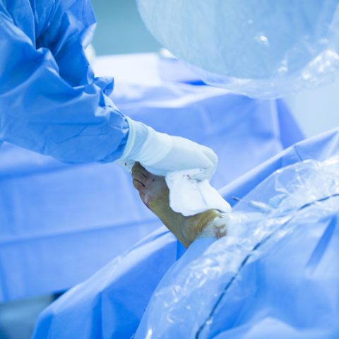 Foot Revision Surgery