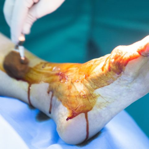 Revision and Salvage Surgeries